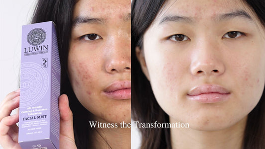 Model transformationwith LUWIN All-rounder Calming & Radiance-Enhancing Facial Mist showcases skin improvements