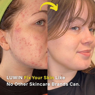 Ultimate Repair & Clear Face Cream for Acne-Prone Skin