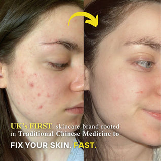 Ultimate Repair & Clear Face Cream for Acne-Prone Skin