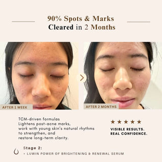 Advanced Clear & Brightening Super Set – Acne & Dark Spot Routine for Clear, Even Skin | LUWIN