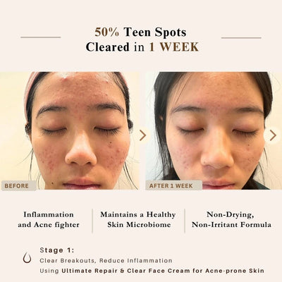 Before-and-after skin comparison graphic showing a woman's face with acne and skin spots, with text claiming 50% teen spots cleared in 1 week and listing benefits like reduced inflammation and a healthy skin microbiome from LUWIN skincare products.
