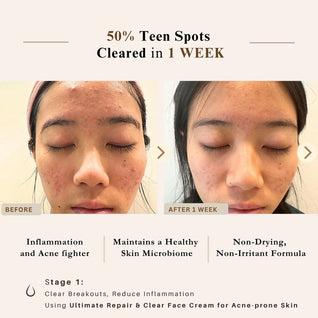 Advanced Clear & Brightening Super Set – Acne & Dark Spot Routine for Clear, Even Skin | LUWIN