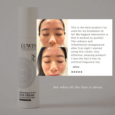 LUWIN face cream for acne prone skin with 'Before' and 'After' skin comparison and a testimonial from a user. 