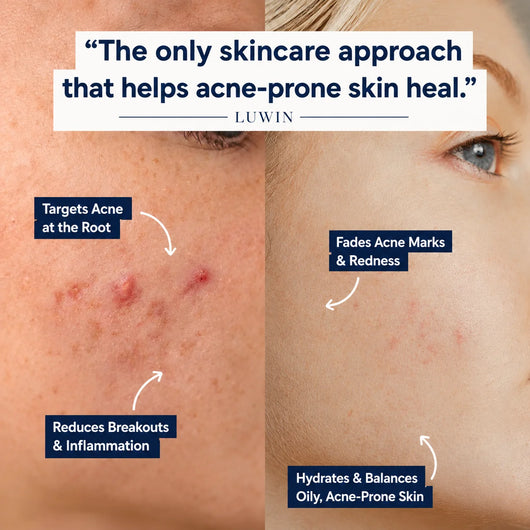 A split-screen skincare comparison graphic showing a close-up of acne-prone skin on the left and clearer skin on the right, with text callouts and the quote, 'The only skincare approach that helps acne-prone skin heal.' by LUWIN.