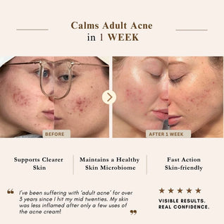 Advanced Calming & Clear Duo – Acne Cream & Calming Mist Set for Clear Skin | LUWIN