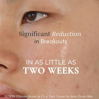 Advanced Clear & Brightening Super Set – Acne & Dark Spot Routine for Clear, Even Skin | LUWIN