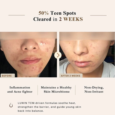 Before-and-after skin comparison graphic for a skincare product, showing a close-up of a person's lower face with acne on the left ('BEFORE') and clearer skin on the right ('AFTER 2 WEEKS'). Text at the top reads '50% Teen Spots Cleared in 2 WEEKS' and lists benefits such as reduced inflammation, healthy microbiome, and non-drying formula.