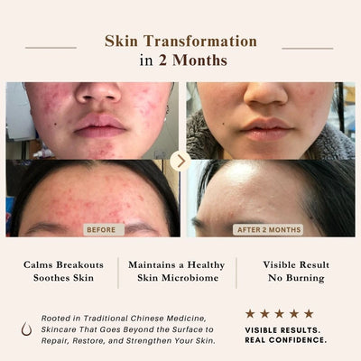 An infographic showing a 2-month skin transformation with before-and-after close-up facial photos of a person's lower face and forehead. Text reads 'Skin Transformation in 2 Months' and lists benefits such as calming breakouts, maintaining a healthy skin microbiome, and visible results by LUWIN skincare UK.