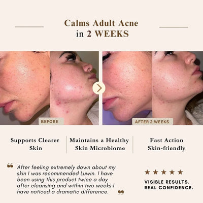 A promotional graphic for an adult acne treatment with before-and-after skin photos of a woman's jawline and cheek, text reading 'Calms Adult Acne in 2 WEEKS,' feature bullet points, a testimonial quote, and a five-star rating on LUWIN skincare products. 