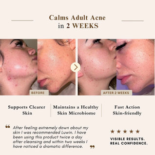 Advanced Clear & Brightening Super Set – Acne & Dark Spot Routine for Clear, Even Skin | LUWIN