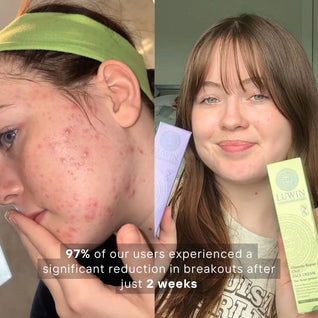 Advanced Calming & Clear Duo – Acne Cream & Calming Mist Set for Clear Skin | LUWIN