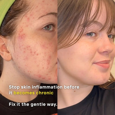 Before-and-after split screen comparison of a woman's face showing acne and skin inflammation on the left, and clearer, calmer skin on the right from using LUWIN skincare products, with text overlay reading 'Stop skin inflammation before it becomes chronic' and 'Fix it the gentle way.'.