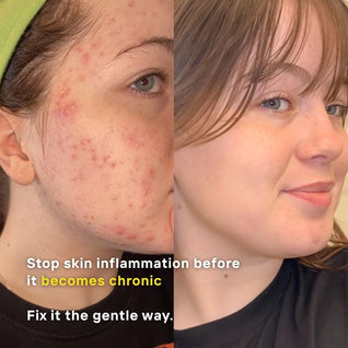 Advanced Clear & Brightening Super Set – Acne & Dark Spot Routine for Clear, Even Skin | LUWIN