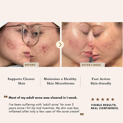 Before-and-after acne treatment results comparison showing a woman's face with active acne breakouts labeled 'BEFORE' and clearer skin labeled 'AFTER 1 WEEK'. The image includes marketing text highlighting benefits such as supporting clearer skin, maintaining a healthy skin microbiome, and fast action skin-friendly results, along with a customer testimonial and a five-star rating  on LUWIN skincare. 