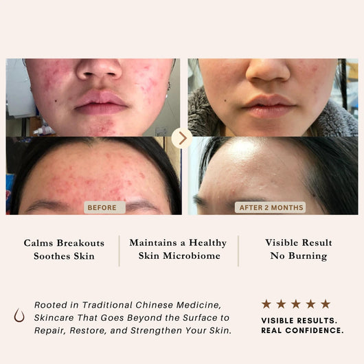 Before-and-after skincare results collage showing a person's face with acne breakouts and clearer skin after two months, accompanied by text claims about calming breakouts, maintaining a healthy skin microbiome, and visible results by  LUWIN skincare. 