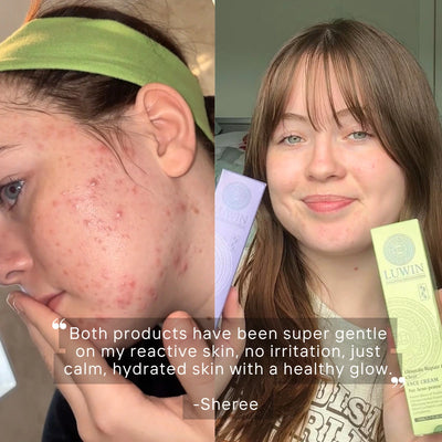 A split-screen before-and-after style skincare testimonial featuring a woman with severe facial acne on the left and clearer skin on the right, holding Luwin skincare products. A quote overlay is visible at the bottom about how skin improved from using  LUWIN skincare. 