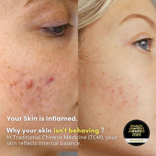 Ultimate Repair & Clear Face Cream for Acne-Prone Skin