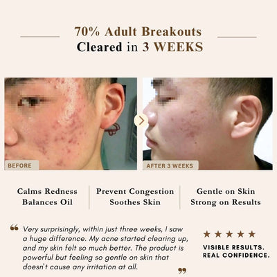 A promotional graphic for a skin treatment showing before-and-after acne results on a man's face, with text claiming 70% adult breakouts cleared in 3 weeks and feature callouts about calming redness, preventing congestion, and gentle on skin  from LUWIN skincare products.