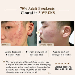 Advanced Clear & Brightening Super Set – Acne & Dark Spot Routine for Clear, Even Skin | LUWIN