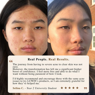 Advanced Clear & Brightening Super Set – Acne & Dark Spot Routine for Clear, Even Skin | LUWIN