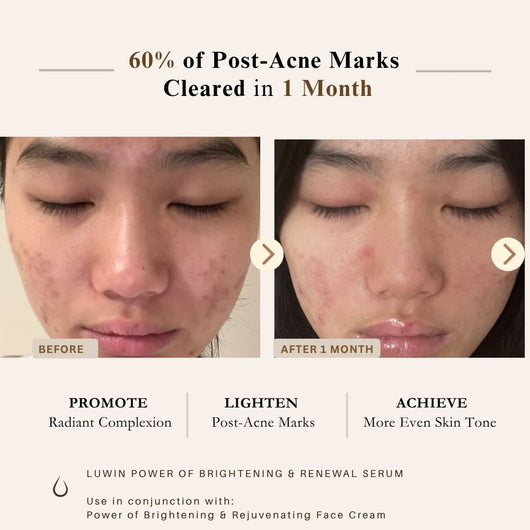 Before-and-after skincare results graphic showing a woman's face with acne marks, with text stating '60% of Post-Acne Marks Cleared in 1 Month' and product name 'LUWIN POWER OF BRIGHTENING & RENEWAL SERUM'.
