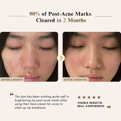 Before-and-after facial skin comparison showing a woman's nose area with acne marks at 1 month and 2 months, with marketing text stating '90% of Post-Acne Marks Cleared in 2 Months' and a customer quote.