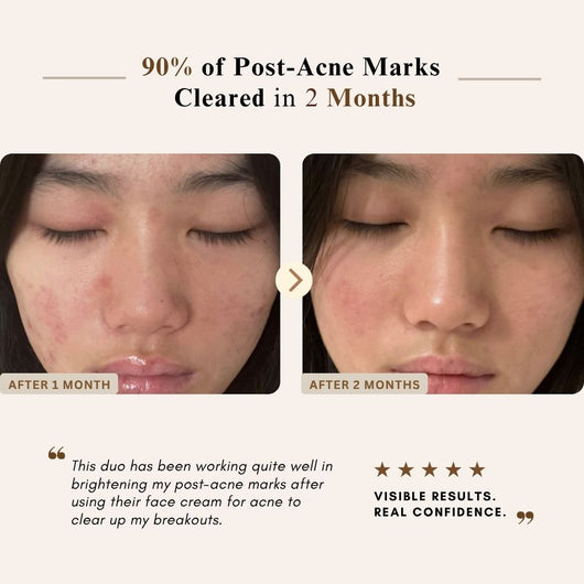 Before-and-after facial skin comparison showing a woman's nose area with acne marks at 1 month and 2 months, with marketing text stating '90% of Post-Acne Marks Cleared in 2 Months' and a customer quote.