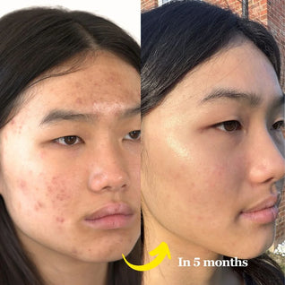 Ultimate Repair & Clear Face Cream for Acne-Prone Skin