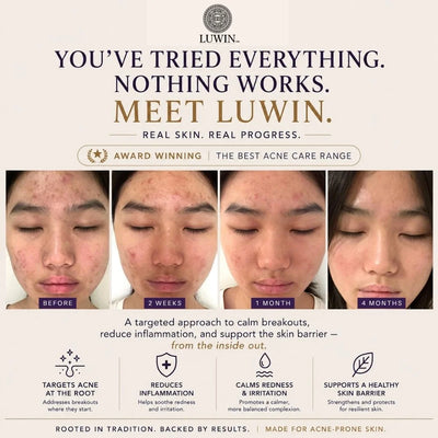 A promotional graphic for Luwin skincare featuring a before-and-after progression of a woman's face showing acne improvement over 4 months, with text reading 'YOU'VE TRIED EVERYTHING. NOTHING WORKS.