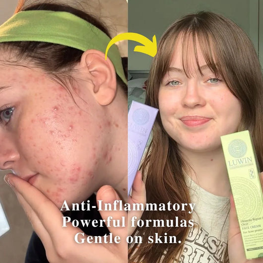 Advanced Clear & Brightening Super Set – Acne & Dark Spot Routine for Clear, Even Skin | LUWIN