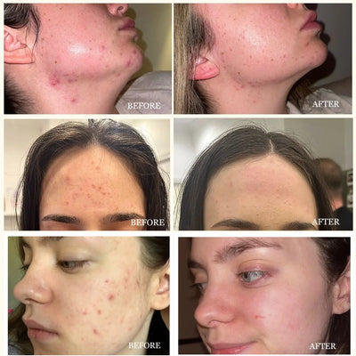 Before and after comparison of acne treatment on three individual users' faces by LUWIN skincare UK.