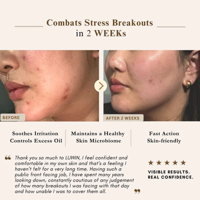 A before-and-after skincare results graphic showing a woman's cheek with acne and redness, labeled 'Before' and 'After 2 Weeks,' under the headline 'Combats Stress Breakouts in 2 WEEKS.' Text below lists benefits such as soothing irritation, controlling excess oil, healthy skin microbiome, and fast action skin-friendly results, with a testimonial and five-star rating on LUWIN products.