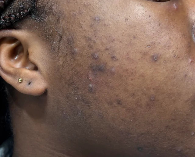 3.It does not make your dark spots worse