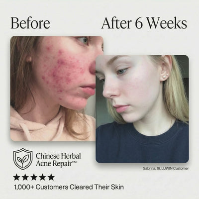 Ultimate Repair & Clear Face Cream for Acne-Prone Skin