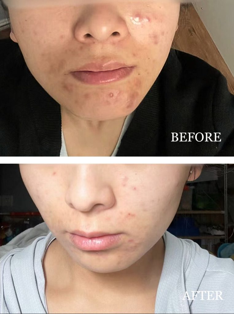 Before-and-after images of Christy’s skin transformation: 'Before' shows breakouts on cheeks and chin; 'After,' clearer skin with reduced acne after 2 weeks of using LUWIN's Ultimate Repair & Clear Face Cream.