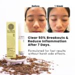 Before and after images of a teenage girl’s face showing significant improvement in acne after using LUWIN Ultimate Repair & Clear Face Cream for one week, accompanied by product packaging and dried herbal ingredients.