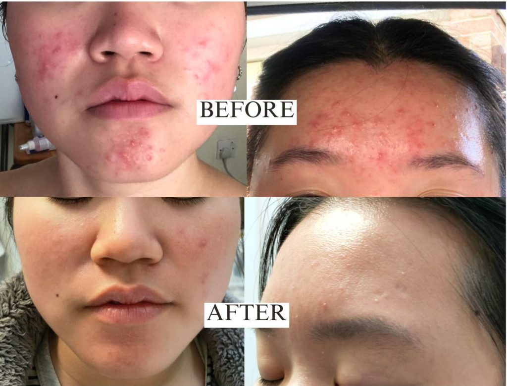 Side-by-side of a teenager's skin: 'Before' shows redness, acne, and inflammation; 'After' reveals clearer, smoother skin