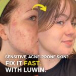 Side-by-side before and after image of a young woman with sensitive, acne-prone skin. The left side shows inflamed, red acne with visible bumps and irritation. The right side reveals clear, smooth skin with a healthy glow and no visible breakouts. Text on the image reads: “Sensitive, acne-prone skin? Fix it fast. With LUWIN.” A yellow arrow points from the before to the after image.