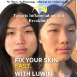 Side-by-side before and after image of a young woman with acne. The left side shows red, inflamed breakouts and uneven skin texture, while the right side reveals clearer, smoother, and calmer skin after using LUWIN. Text on the image reads: “No Filters, No Photoshop – what you see is what you get. Targets Inflammation and Breakout! Fix your skin. Fast. With LUWIN.”
