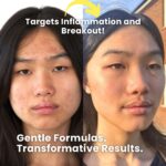 Side-by-side before and after image of a young woman with acne. The left side shows red, inflamed breakouts and uneven skin texture, while the right side reveals clearer, smoother, and calmer skin after using LUWIN. Text on the image reads: Target inflammation and breakouts! Gentle formulas. transformative results.