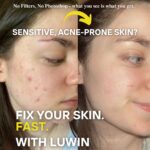 Side-by-side before and after image of a young woman with acne-prone skin. The left side shows red, inflamed blemishes on her cheek, while the right side reveals visibly clearer, smoother skin after using LUWIN. Text on image reads: “No Filters, No Photoshop – what you see is what you get. Fix your skin. Fast. With LUWIN.”