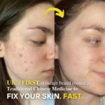 This side-by-side image shows the impressive skin transformation of a young woman with acne-prone skin. On the left (before), her cheek is visibly inflamed with clusters of red blemishes and breakouts. On the right (after), her skin appears significantly clearer, with a smoother, calmer texture and only faint traces of previous breakouts. A yellow arrow visually connects the transformation. The overlay text states: “UK’s FIRST skincare brand rooted in Traditional Chinese Medicine to FIX YOUR SKIN. FAST.” — highlighting both the unique heritage and the effectiveness of the skincare line.