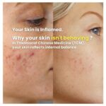 A before-and-after comparison highlights the transformative results of LUWIN Ultimate Repair & Clear Face Cream for acne-prone skin. The left image shows stubborn acne spots, while the right reveals visibly clearer and smoother skin after just two weeks. Text says Your skin is inflamed, and why your skin isn't behaving? In traditional chinese medicine, your skin reflects internal balances.