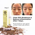 Before and after images of a teenage girl’s face showing significant improvement in acne after using LUWIN Ultimate Repair & Clear Face Cream for one week as stage 1 with LUWIN products, accompanied by product packaging and dried herbal ingredients.