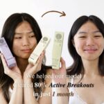 A side-by-side model transformation with 80% active breakouts cleared using LUWIN All-rounder Calming & Radiance-Enhancing Facial Mist and Ultimate Repair & Clear Face Cream, shows clearer skin after 1 month.