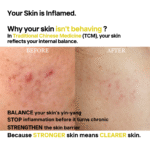 Before and after side by side skin with redness and acne prone skin with text overlay saying that skin needs to be in balance to behave and to strengthen skin barrier.