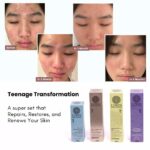 A skin journey from severe breakouts to clear skin images of a teenage's face showing progressive improvement of acne-prone skin using LUWIN skincare products, alongside product boxes and labelled stages of transformation.