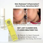 Before and after comparison showing improved skin clarity and reduced redness after two weeks using LUWIN Ultimate Repair & Clear Face Cream for acne-prone skin. The image features the product bottle and packaging alongside text highlighting benefits such as no steroids, no harsh chemicals, barrier repair, and non-irritating fast action.