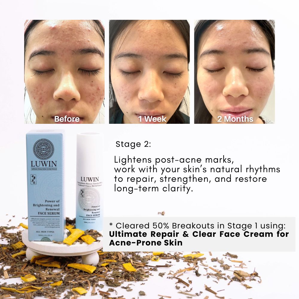 Photo slides (10) Before and after images of a teenage girlās face showing significant improvement in acne after using LUWIN Powerful Brightening & Renewal face serum, accompanied by product packaging and dried herbal ingredients. images from before to 1 week then 2 month with massive clearer skin and improvement in complexion. text says Lightens post-acne marks, work with your skinās natural rhythms to repair, strengthen, and restore long-term clarity as stage 2, where stage 1 cleared 50% breakouts using ultimate repair & clear face cream for acne-prone skin.