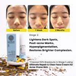 Before and after images of a teenage girl’s face showing significant improvement in acne after using LUWIN Powerful Brightening & Renewal face serum, accompanied by product packaging and dried herbal ingredients.images from before to 1 week then 2 month with massive clearer skin and improvement in complexion. text says lightens dark spot, post-acen marks, hyperpigmentation, and restores brighter complexion as stage 2, stage 1 cleared 50% breakouts using ultimate repair & clear face cream for acne-prone skin.